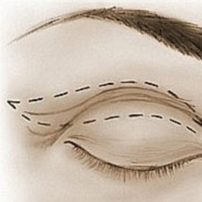 Cirurgia Plástica Ocular