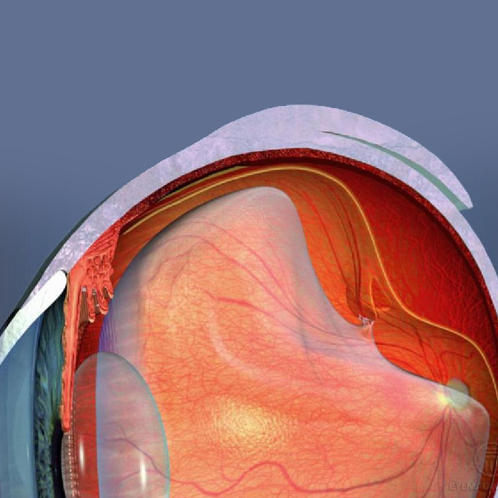 Retina Cirúrgica